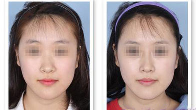 自體脂肪豐額頭效果對(duì)比?