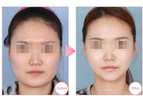 自體脂肪豐太陽(yáng)穴前后對(duì)?