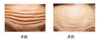 肉毒素除動(dòng)態(tài)抬頭紋對(duì)比?