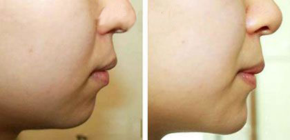 膠原蛋白豐下巴對(duì)比圖?