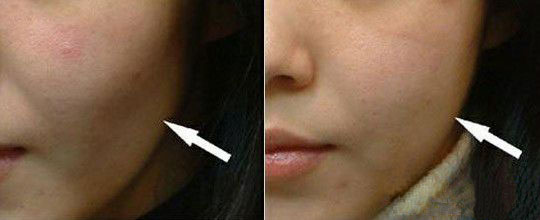 豐面頰對(duì)比圖?
