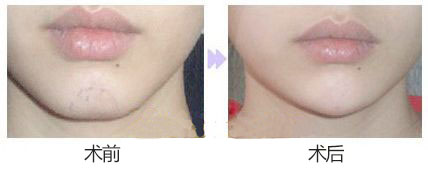 玻尿酸豐下巴前后對(duì)比圖?