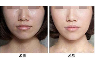 自體脂肪去除面部衰老皺?