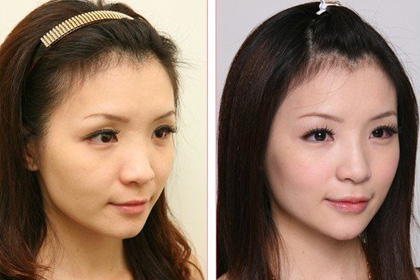 隆鼻子真人實(shí)拍對(duì)比圖