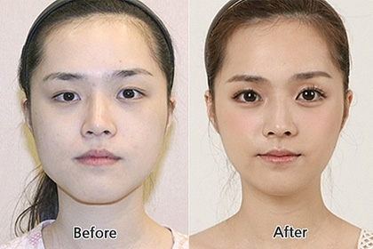 隆鼻前后對(duì)比圖