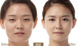 切開(kāi)雙眼皮到底哪家醫(yī)院?