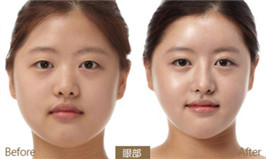 雙眼皮手術(shù)到底有哪些做?