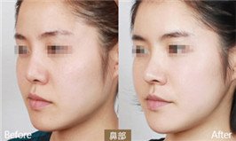 玻尿酸隆鼻效果對(duì)比圖