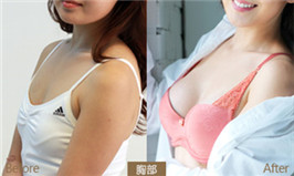 注射隆胸前后對(duì)比圖?