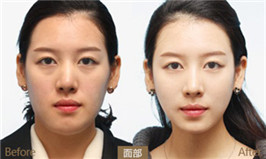 下巴整形對(duì)比圖?