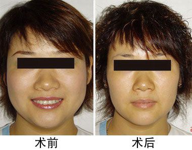 肉毒素瘦臉對(duì)比圖?