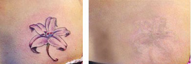 激光去紋身前后對(duì)比圖?